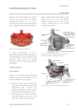 Inferior Maxillectomy