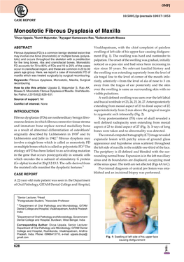 Monostotic Fibrous Dysplasia of Maxilla 1Divya Uppala, 2Sumit Majumdar, 3Ayyagari Kameswara Rao, 4Sailendranath Biswas