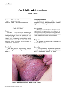 Epidermolytic Acanthoma