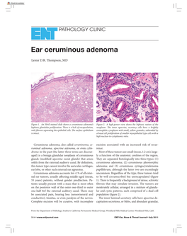 Ear Ceruminous Adenoma