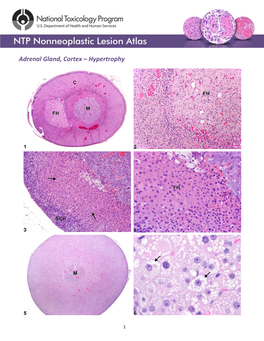 Adrenal Gland, Cortex – Hypertrophy