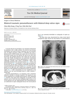 Bilateral Traumatic Pneumothoraces with Bilateral Deep Sulcus Signs