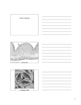 Aortic Stenosis