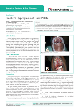 Smokers Hyperplasia of Hard Palate