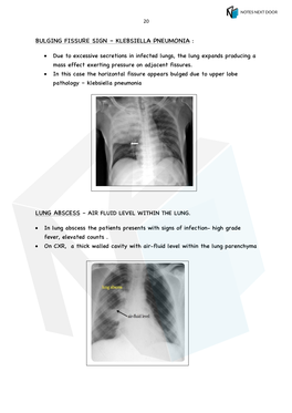 Bulging Fissure Sign – Klebsiella Pneumonia