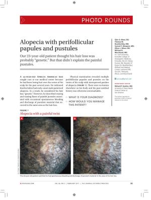 Alopecia with Perifollicular Papules and Pustules