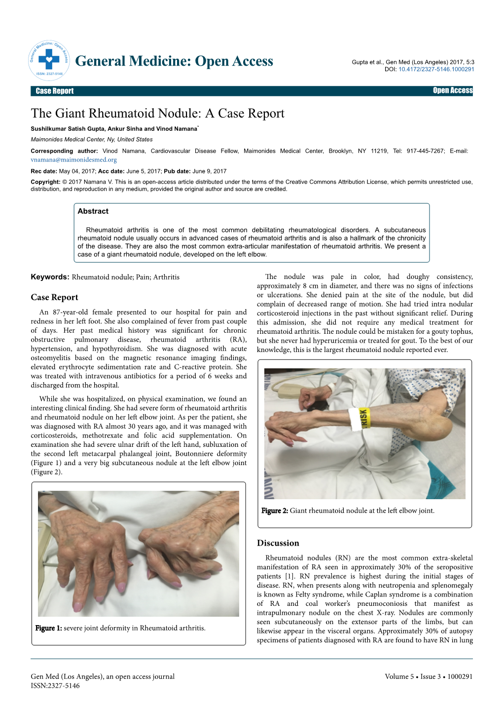 The Giant Rheumatoid Nodule: a Case Report