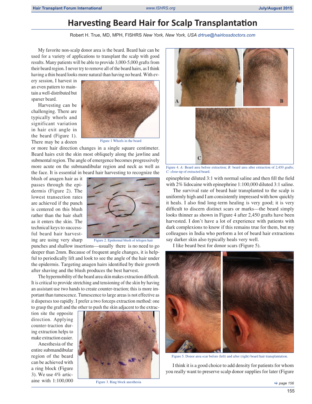 Harvesting Beard Hair for Scalp Transplantation