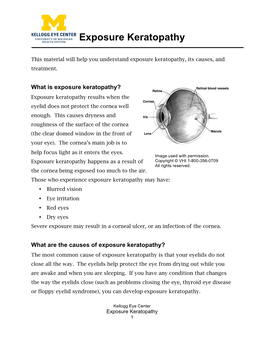 Exposure Keratopathy