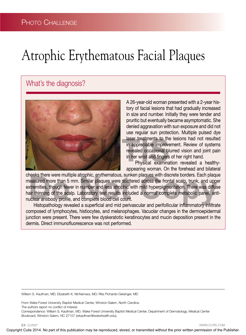 Atrophic Erythematous Facial Plaques