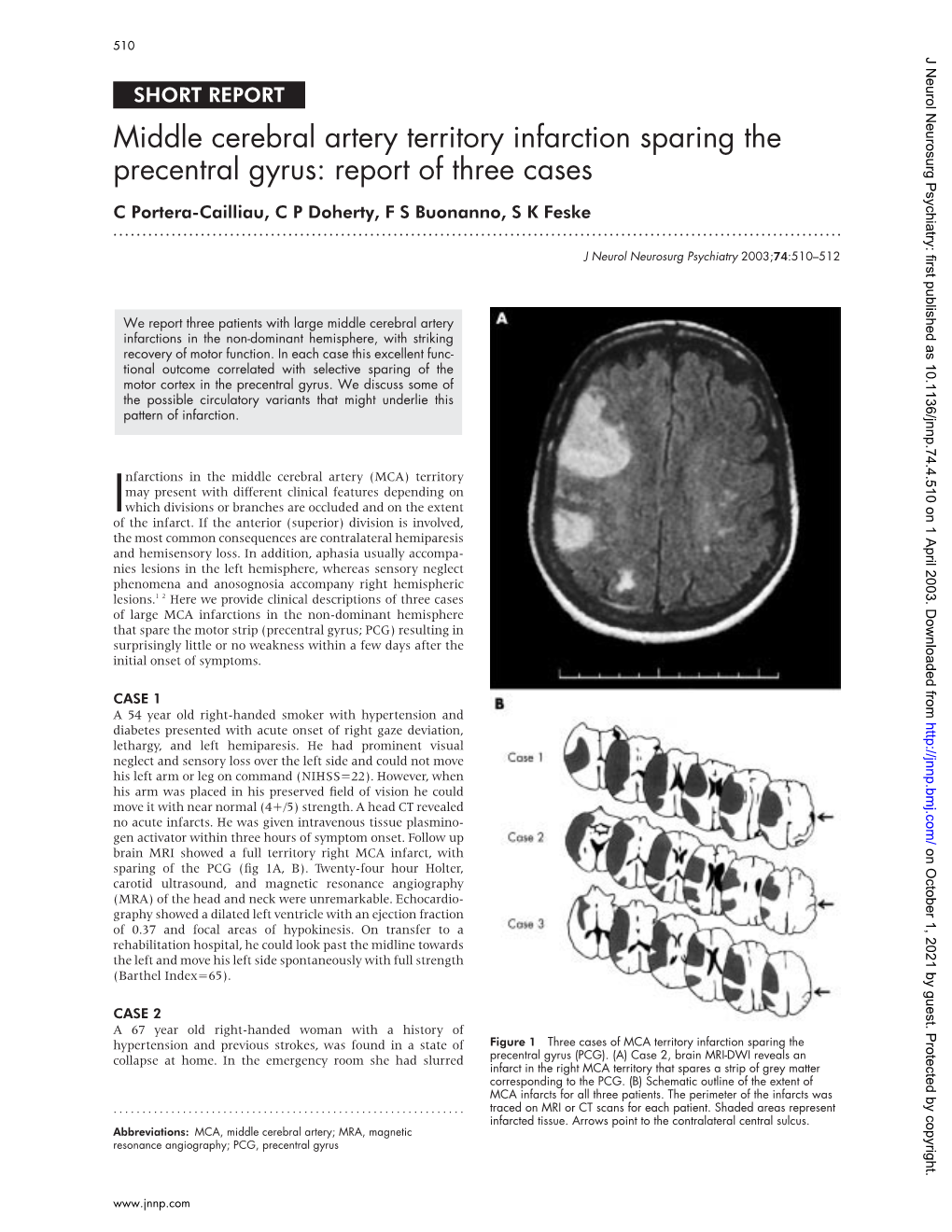 Middle Cerebral Artery Territory Infarction Sparing the Precentral Gyrus: Report of Three Cases C Portera-Cailliau, C P Doherty, F S Buonanno, S K Feske