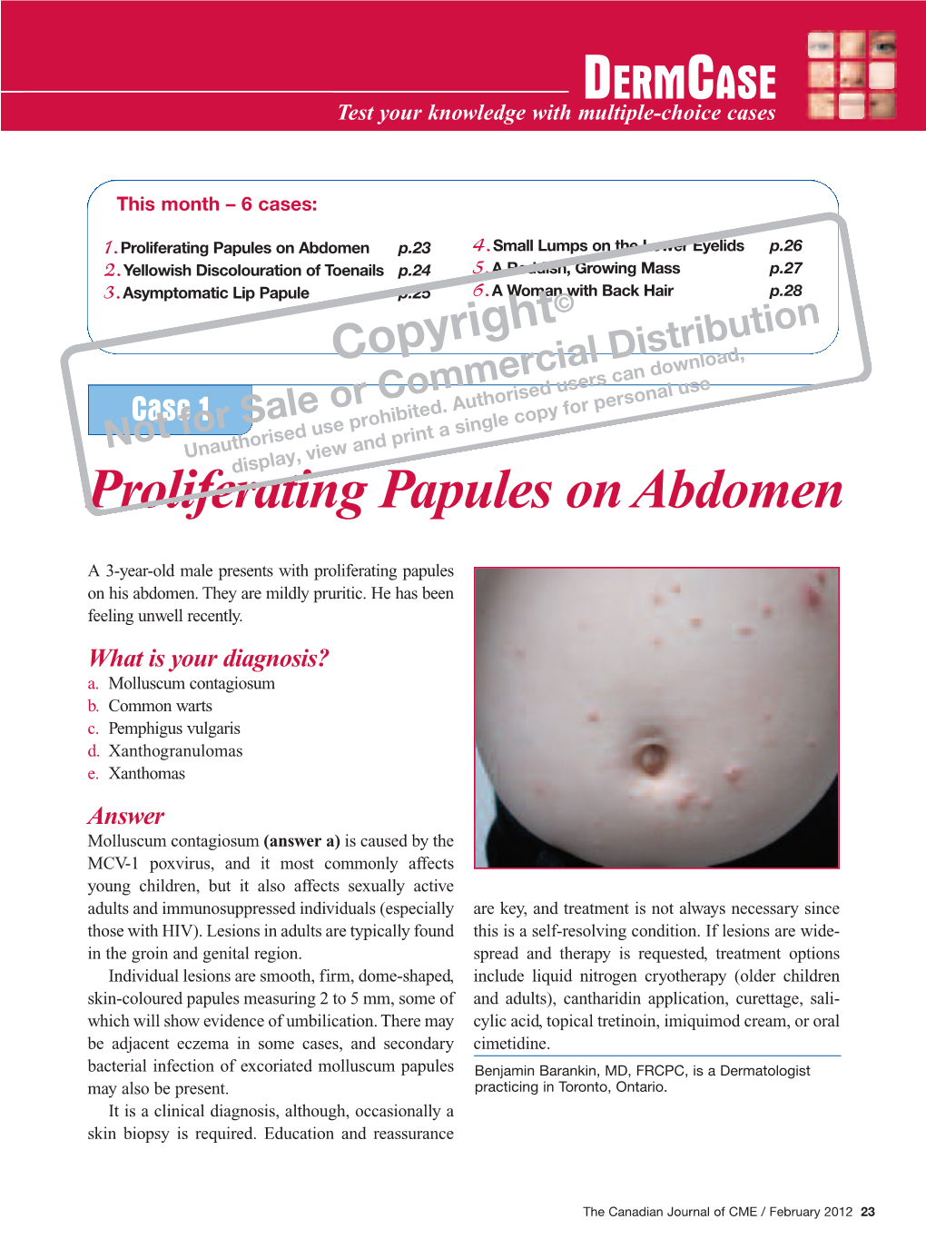 Proliferating Papules on Abdomen