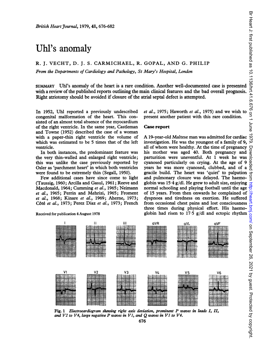 Uhl's Anomaly