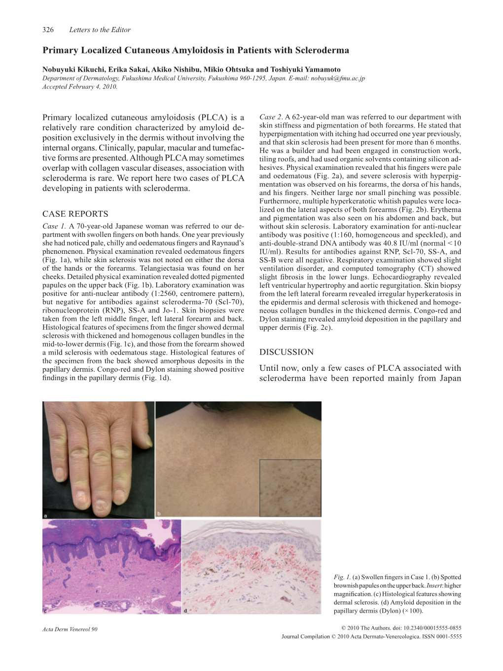 Primary Localized Cutaneous Amyloidosis in Patients with Scleroderma