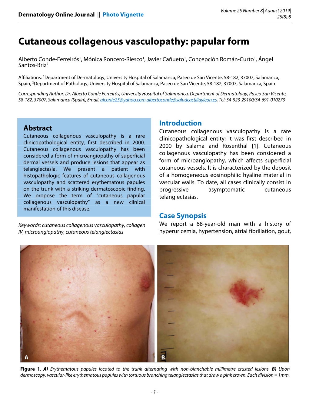 Cutaneous Collagenous Vasculopathy: Papular Form