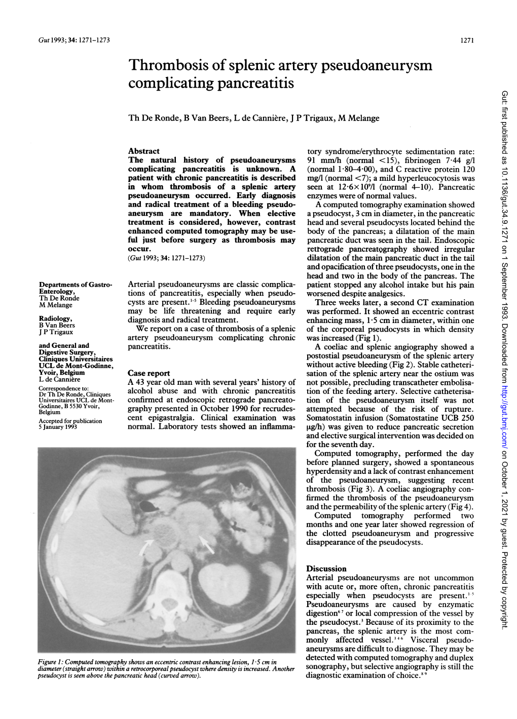 Thrombosis of Splenic Artery Pseudoaneurysm Complicating Pancreatitis