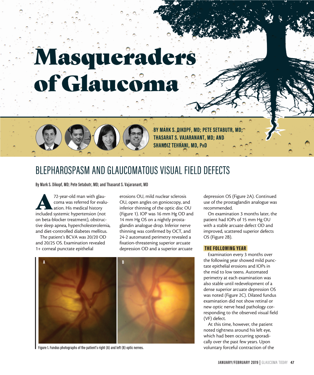 Masqueraders of Glaucoma