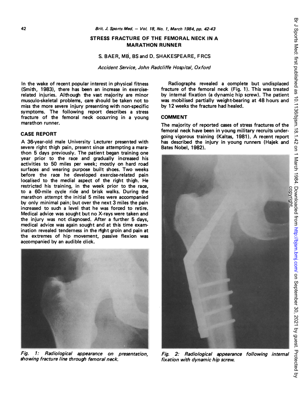 Stress Fracture of the Femoral Neck in a Marathon Runner S