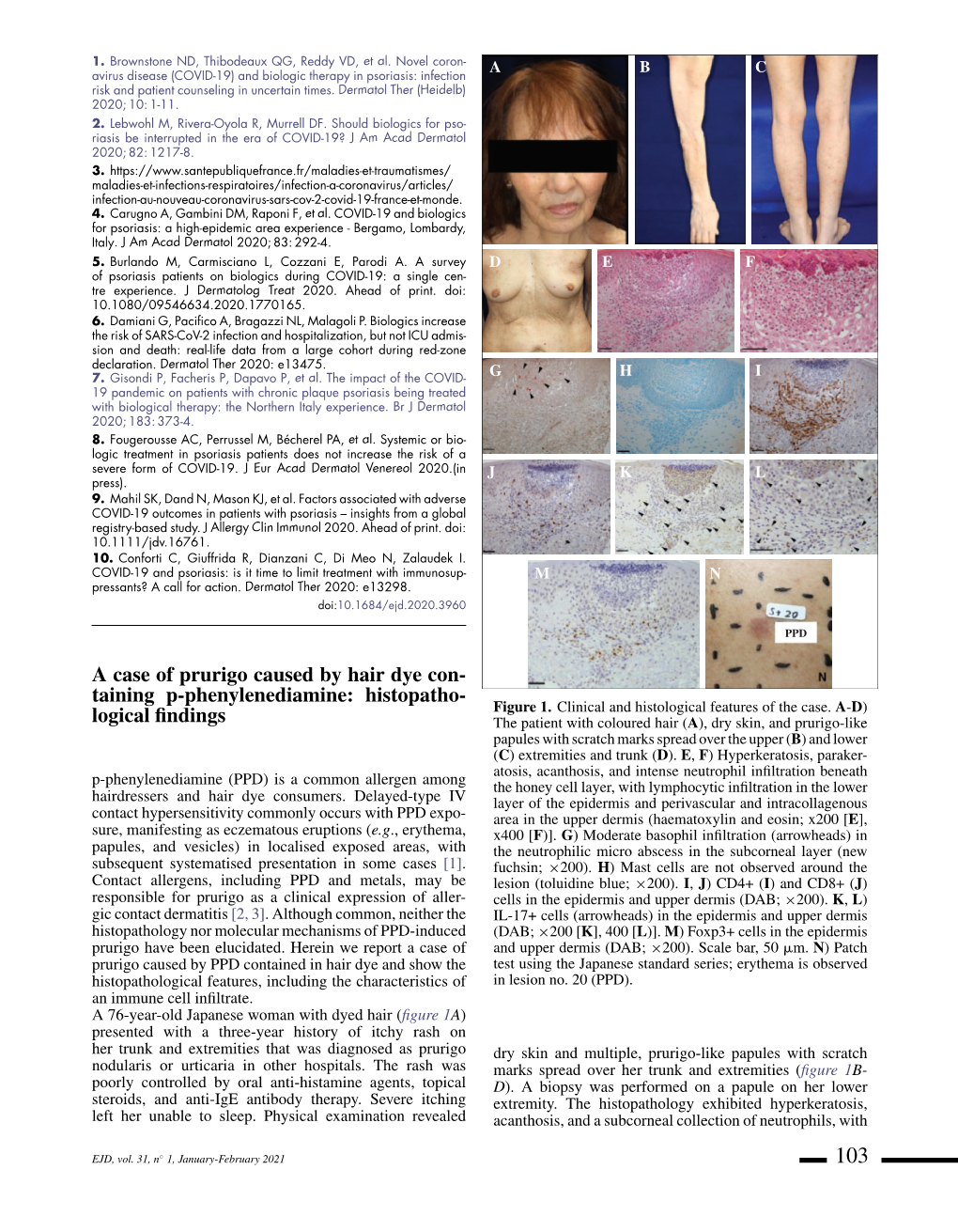 A Case of Prurigo Caused by Hair Dye Con- Taining P-Phenylenediamine: Histopatho- Figure 1
