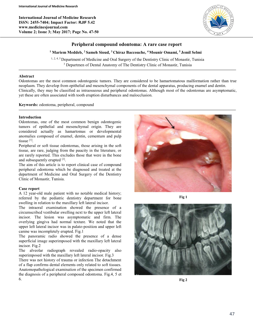 47 Peripheral Compound Odontoma: a Rare Case Report