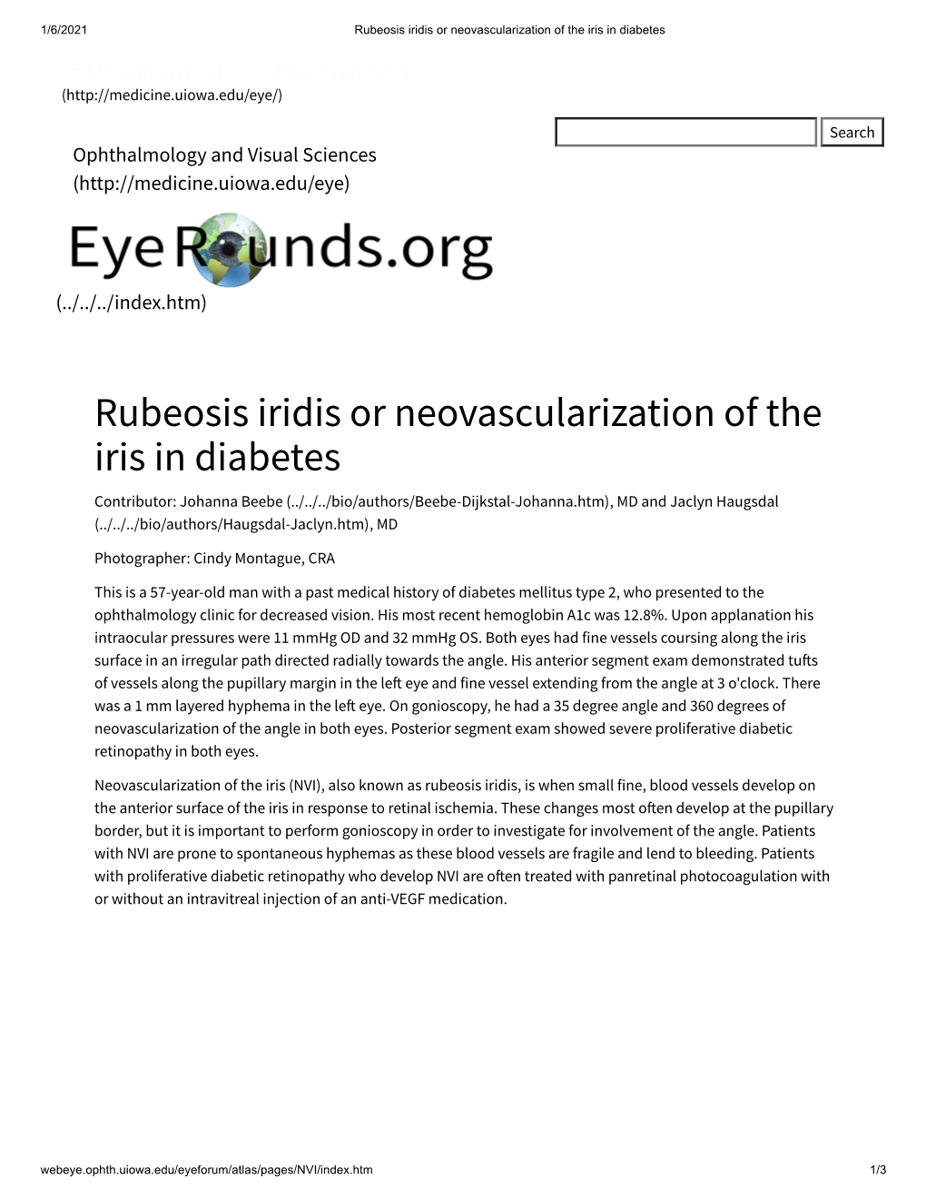 Rubeosis Iridis Or Neovascularization of the Iris in Diabetes