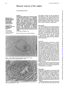 Brenner Tumour of the Vagina