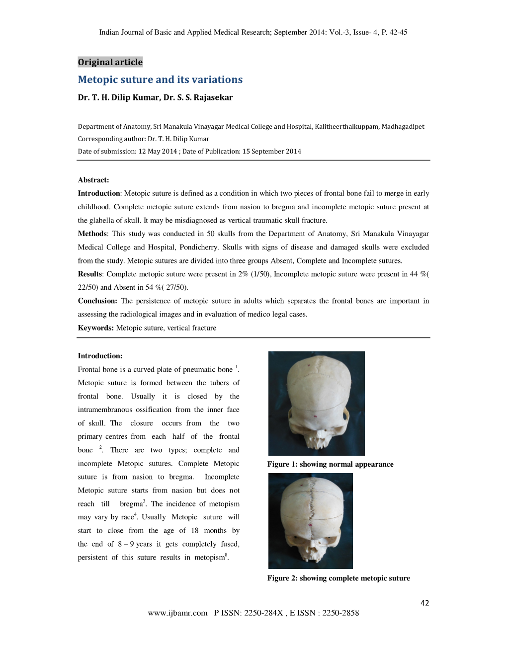 Metopic Suture and Its Variations Dr