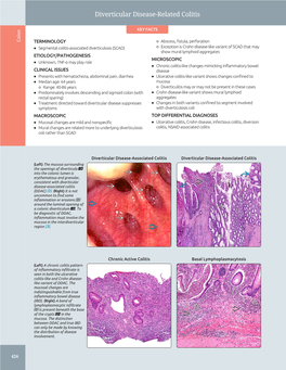 Diverticular Disease-Related Colitis