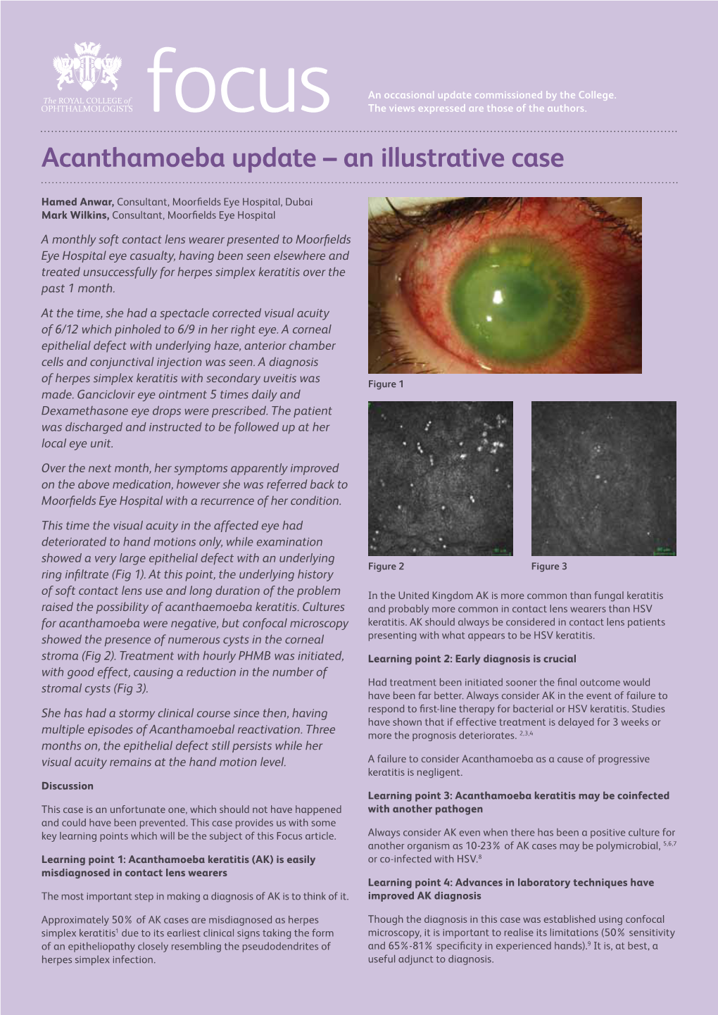 Acanthamoeba Update – an Illustrative Case