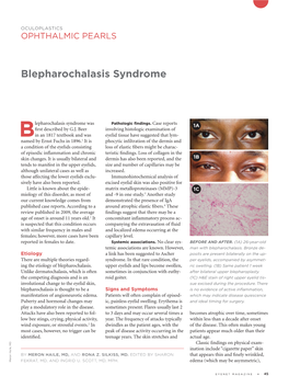 Blepharochalasis Syndrome