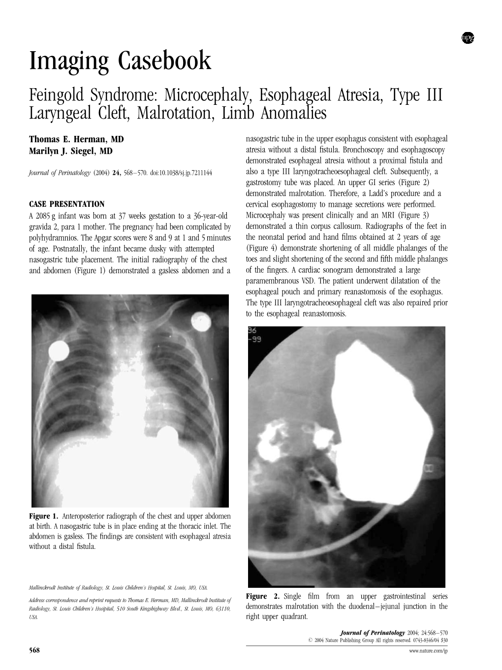 Imaging Casebook Feingold Syndrome: Microcephaly, Esophageal Atresia, Type III Laryngeal Cleft, Malrotation, Limb Anomalies