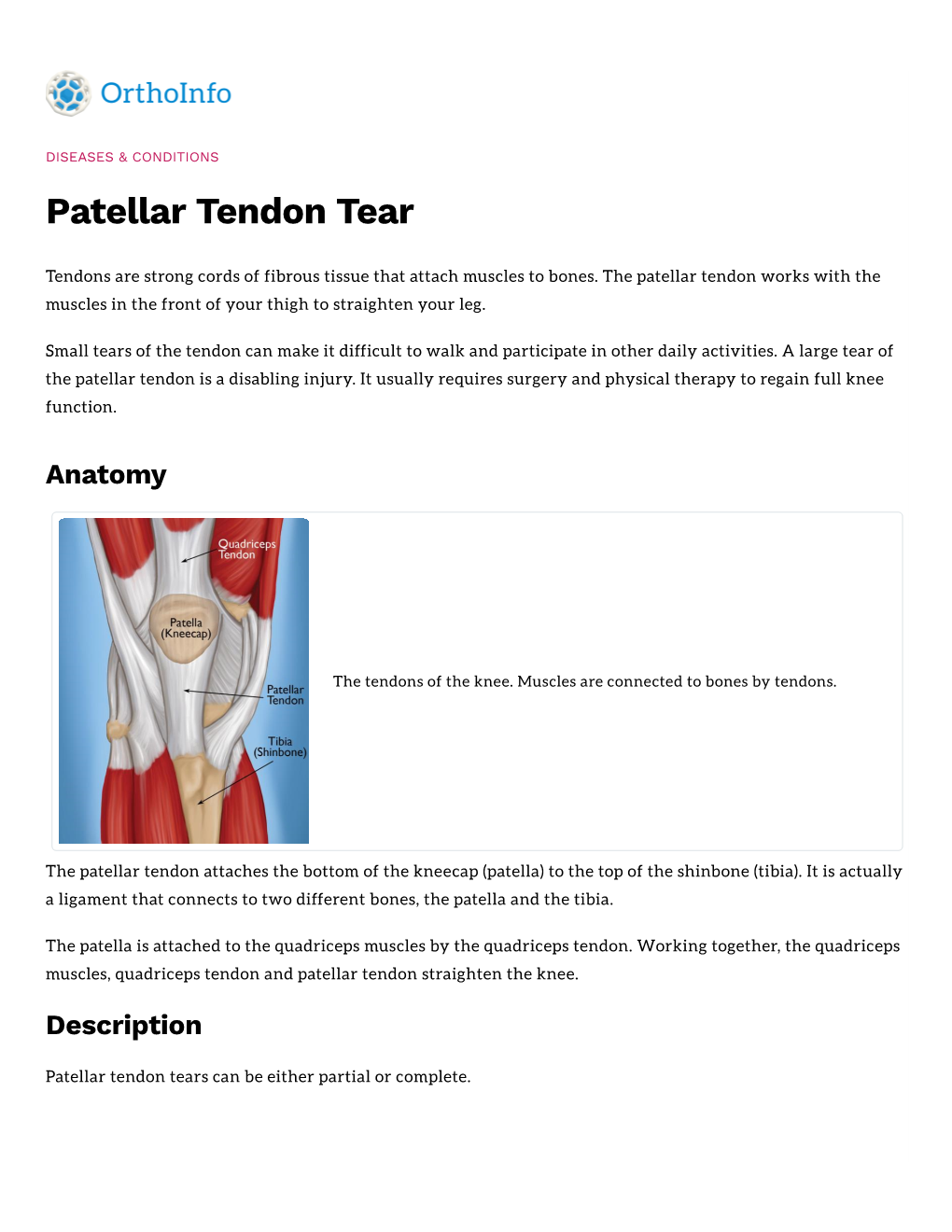 Patellar Tendon Tear