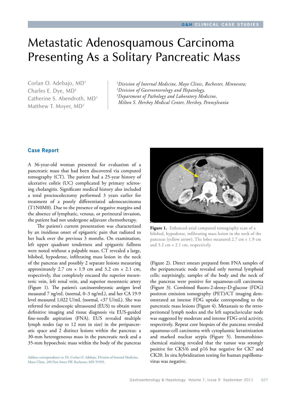 Metastatic Adenosquamous Carcinoma Presenting As a Solitary Pancreatic Mass