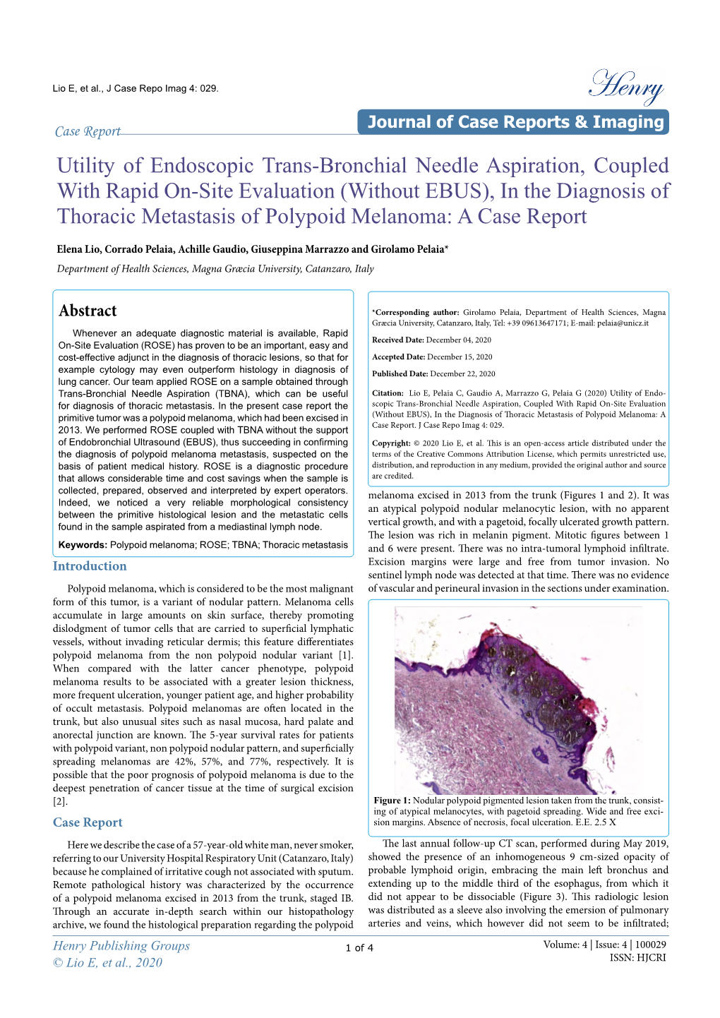 Utility of Endoscopic Trans-Bronchial Needle Aspiration, Coupled With