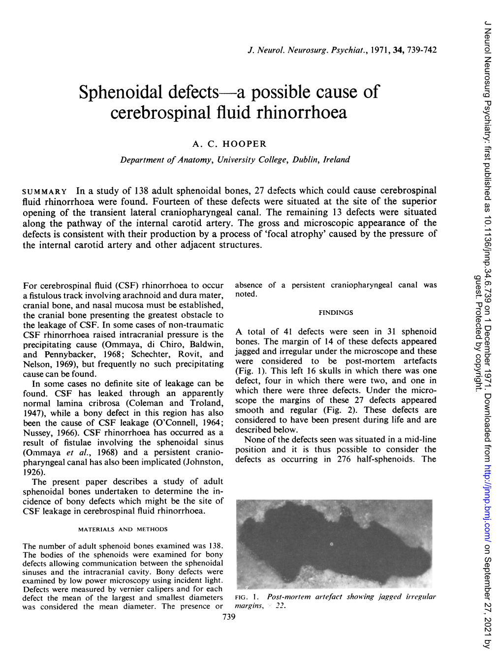 Sphenoidal Defects-A Possible Cause of Cerebrospinal Fluid Rhinorrhoea