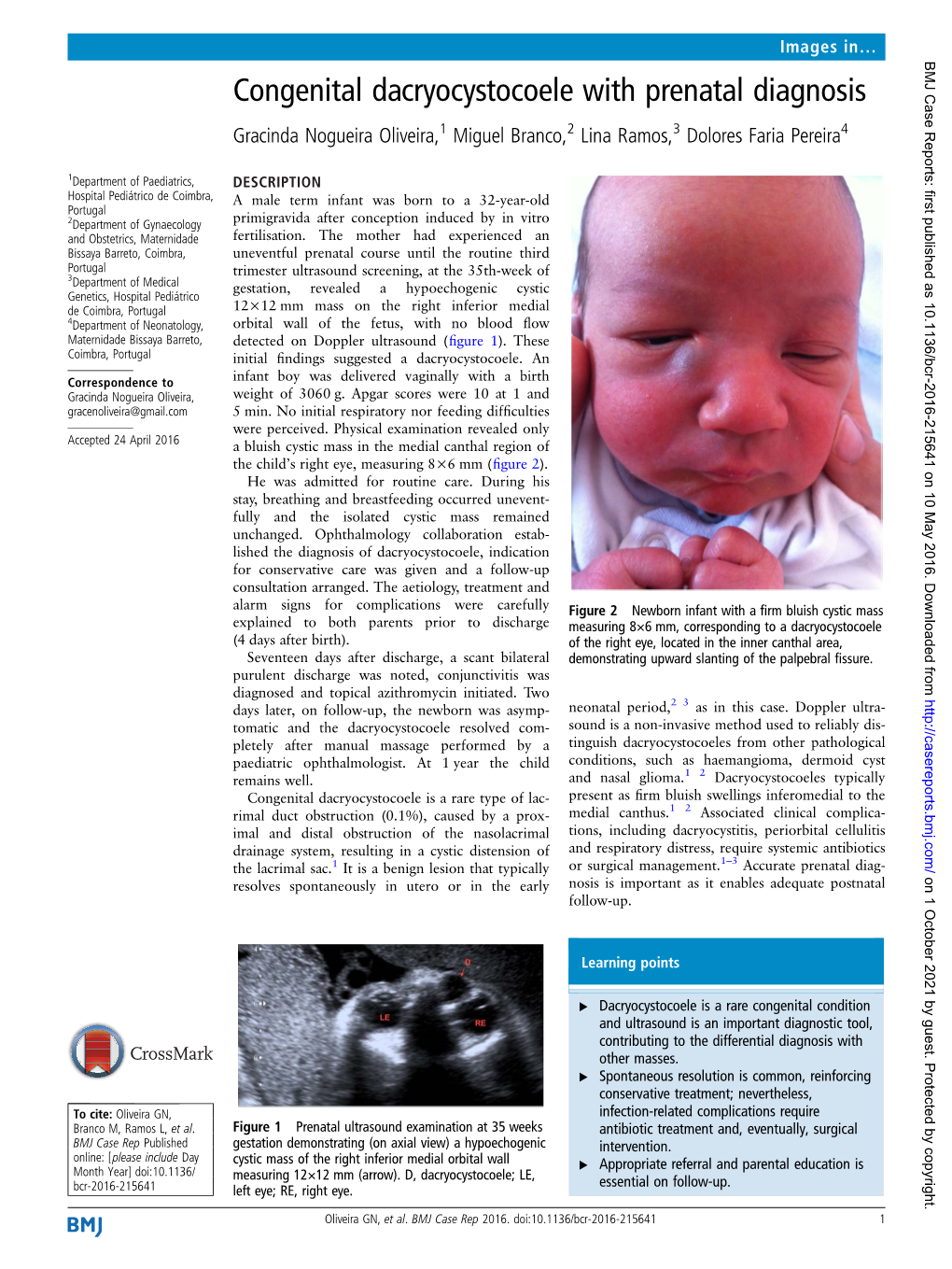 Congenital Dacryocystocoele with Prenatal Diagnosis Gracinda Nogueira Oliveira,1 Miguel Branco,2 Lina Ramos,3 Dolores Faria Pereira4