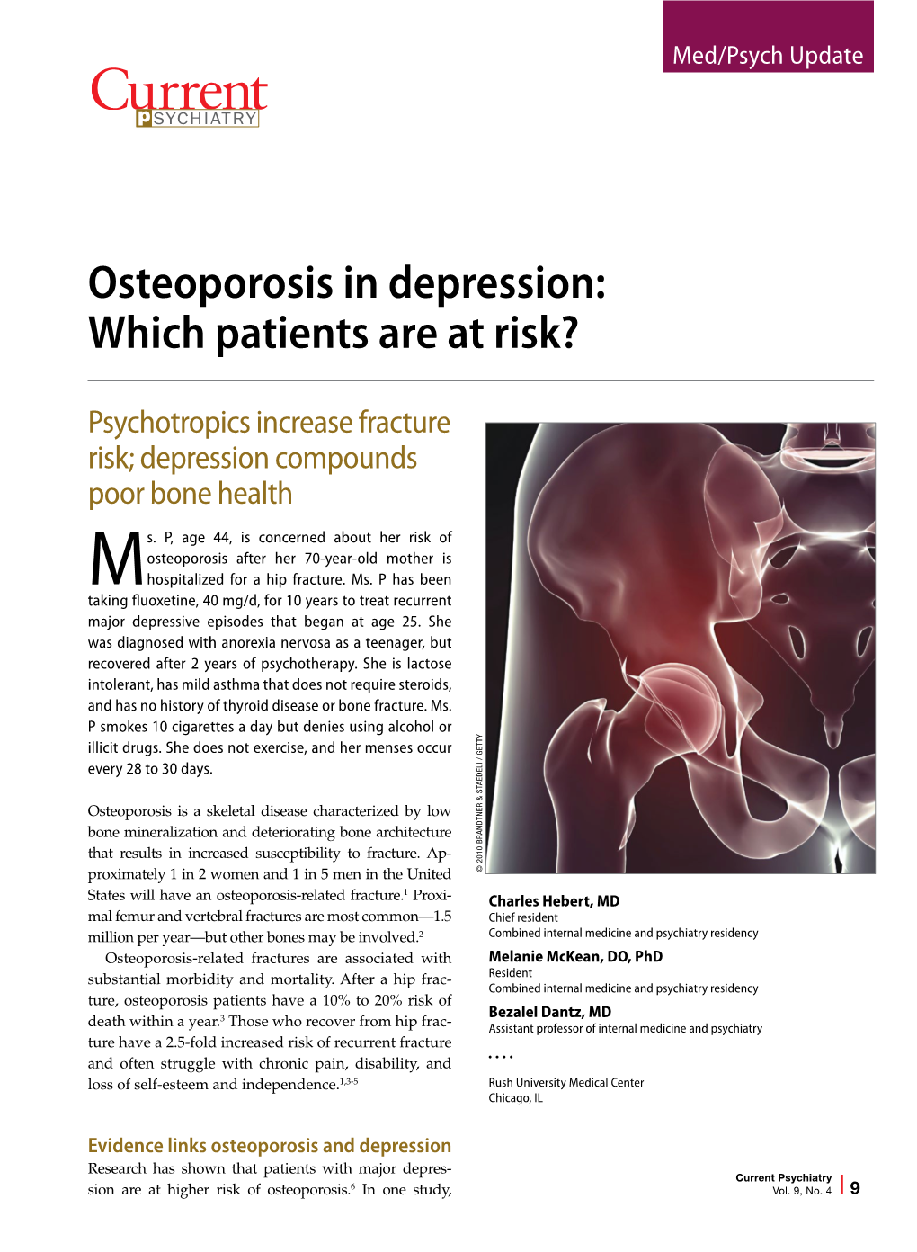 Osteoporosis in Depression: Which Patients Are at Risk?