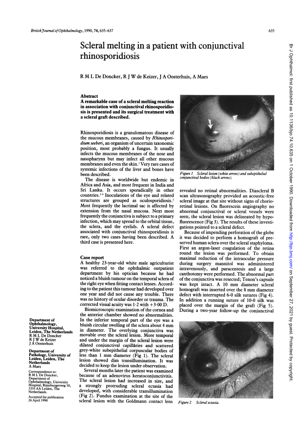 Scleral Melting in a Patient with Conjunctival Br J Ophthalmol: First Published As 10.1136/Bjo.74.10.635 on 1 October 1990