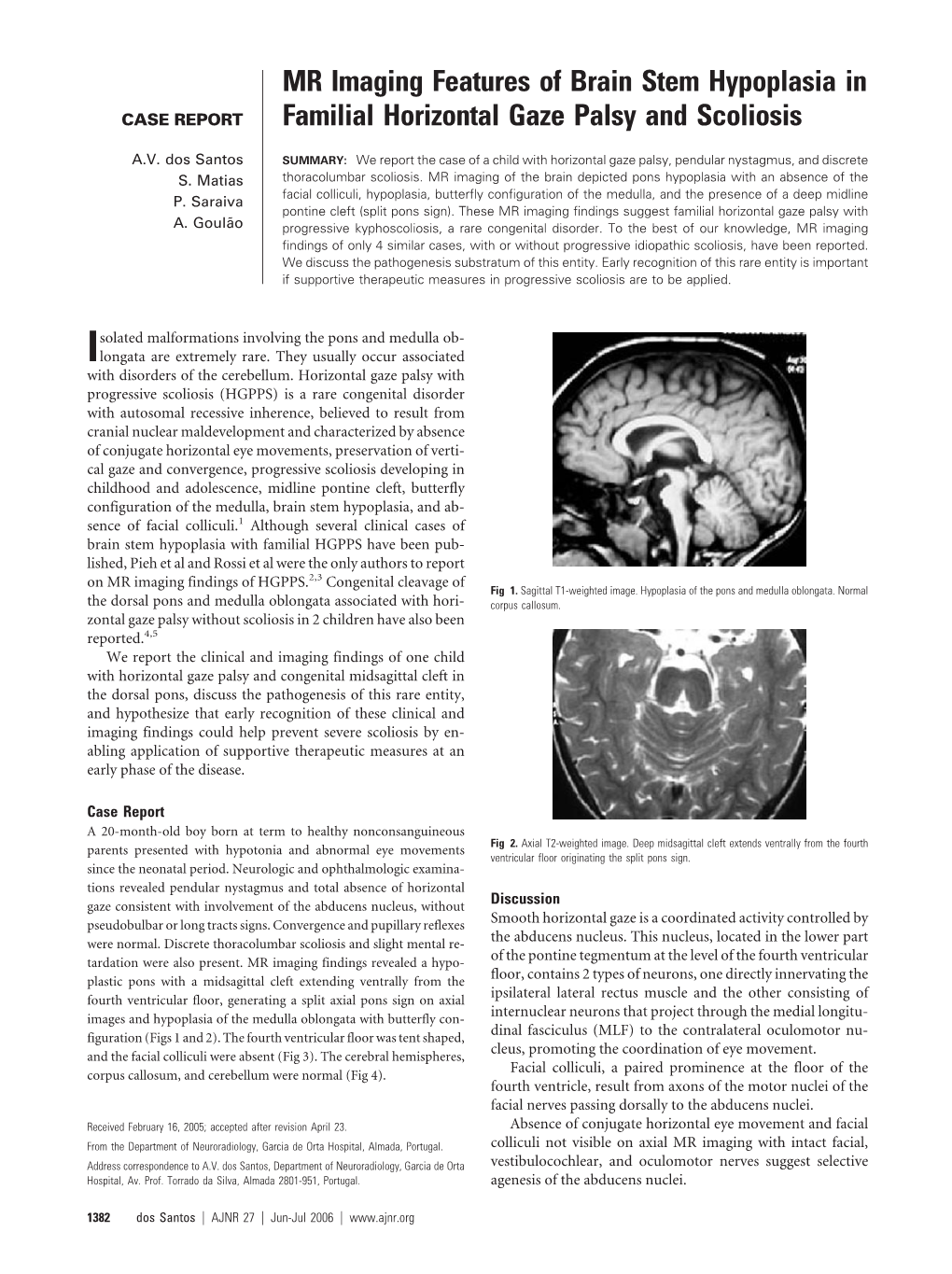 MR Imaging Features of Brain Stem Hypoplasia in Familial Horizontal