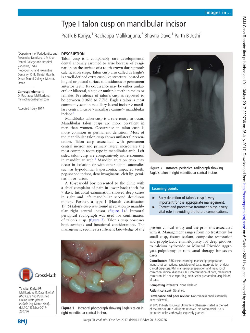 Type I Talon Cusp on Mandibular Incisor Pratik B Kariya,1 Rachappa Mallikarjuna,2 Bhavna Dave,1 Parth B Joshi1