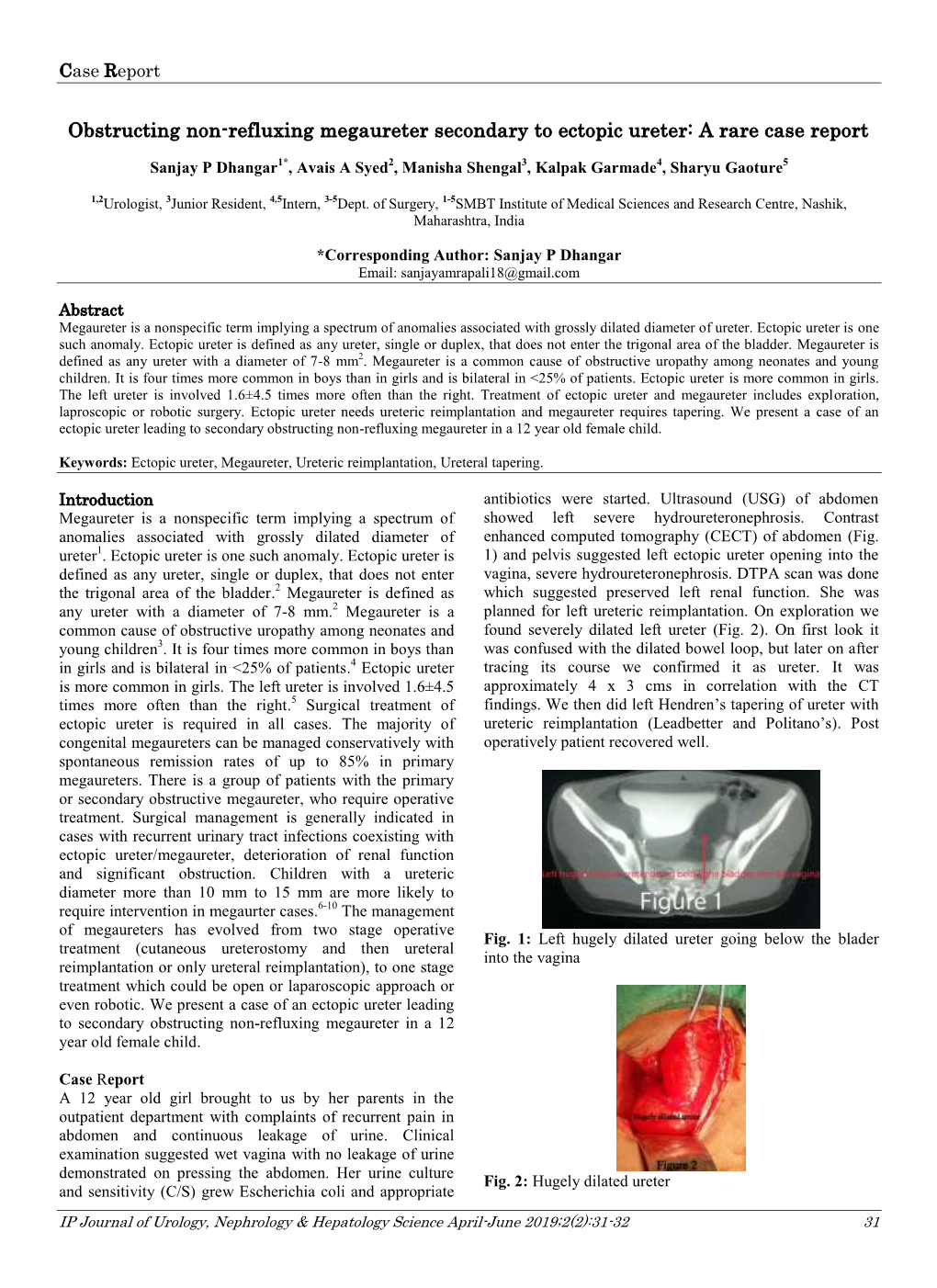 Obstructing Non-Refluxing Megaureter Secondary to Ectopic Ureter: a Rare Case Report