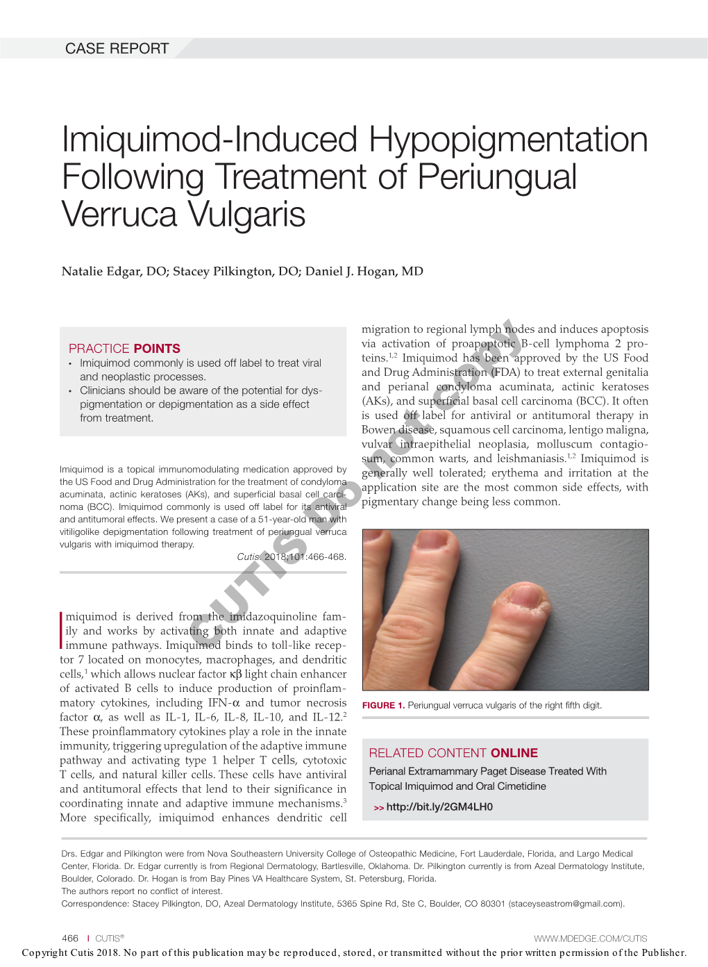 Imiquimod-Induced Hypopigmentation Following Treatment of Periungual Verruca Vulgaris