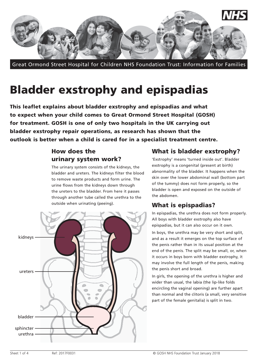 Bladder Exstrophy and Epispadias