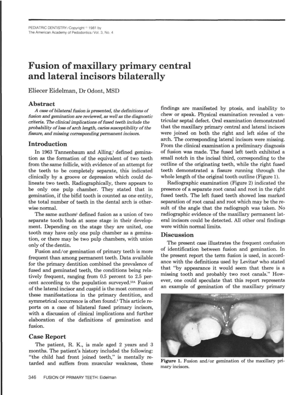 Fusion of Maxillary Primary Central and Lateral Incisors Bilaterally Eliecer Eidelman, Dr Odont, MSB