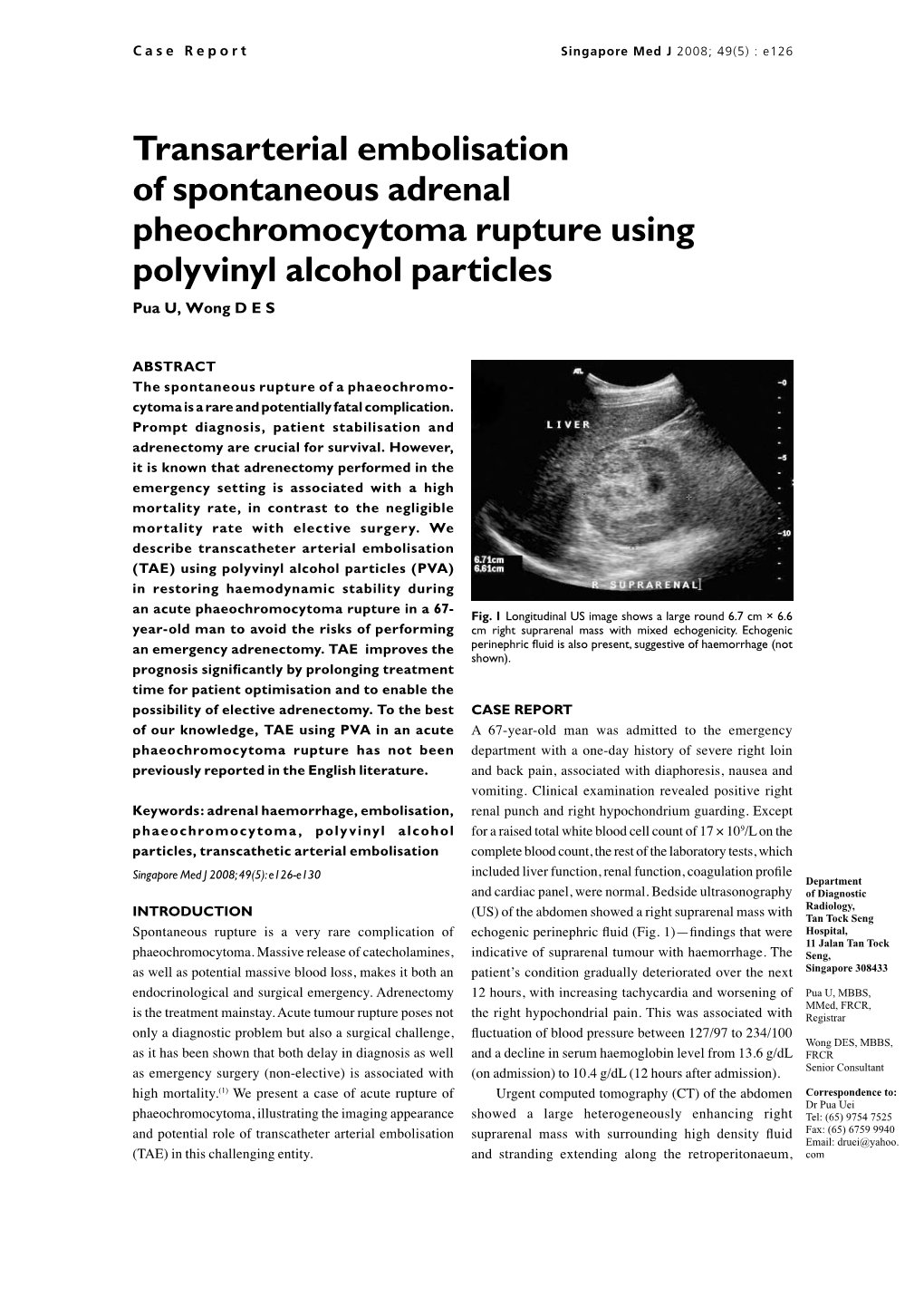 Transarterial Embolisation of Spontaneous Adrenal Pheochromocytoma Rupture Using Polyvinyl Alcohol Particles Pua U, Wong D E S