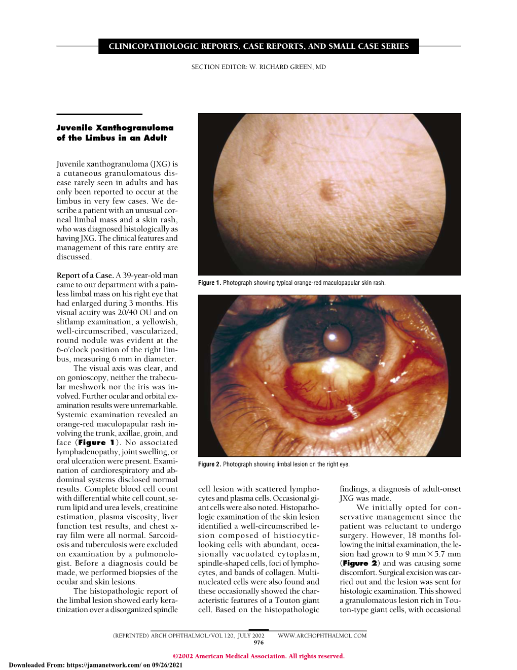 Juvenile Xanthogranuloma of the Limbus in an Adult