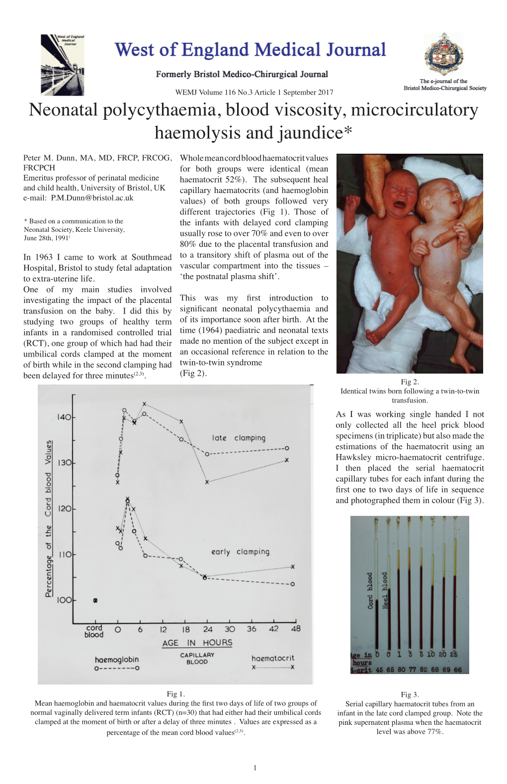 Neonatal Polycythaemia.Indd