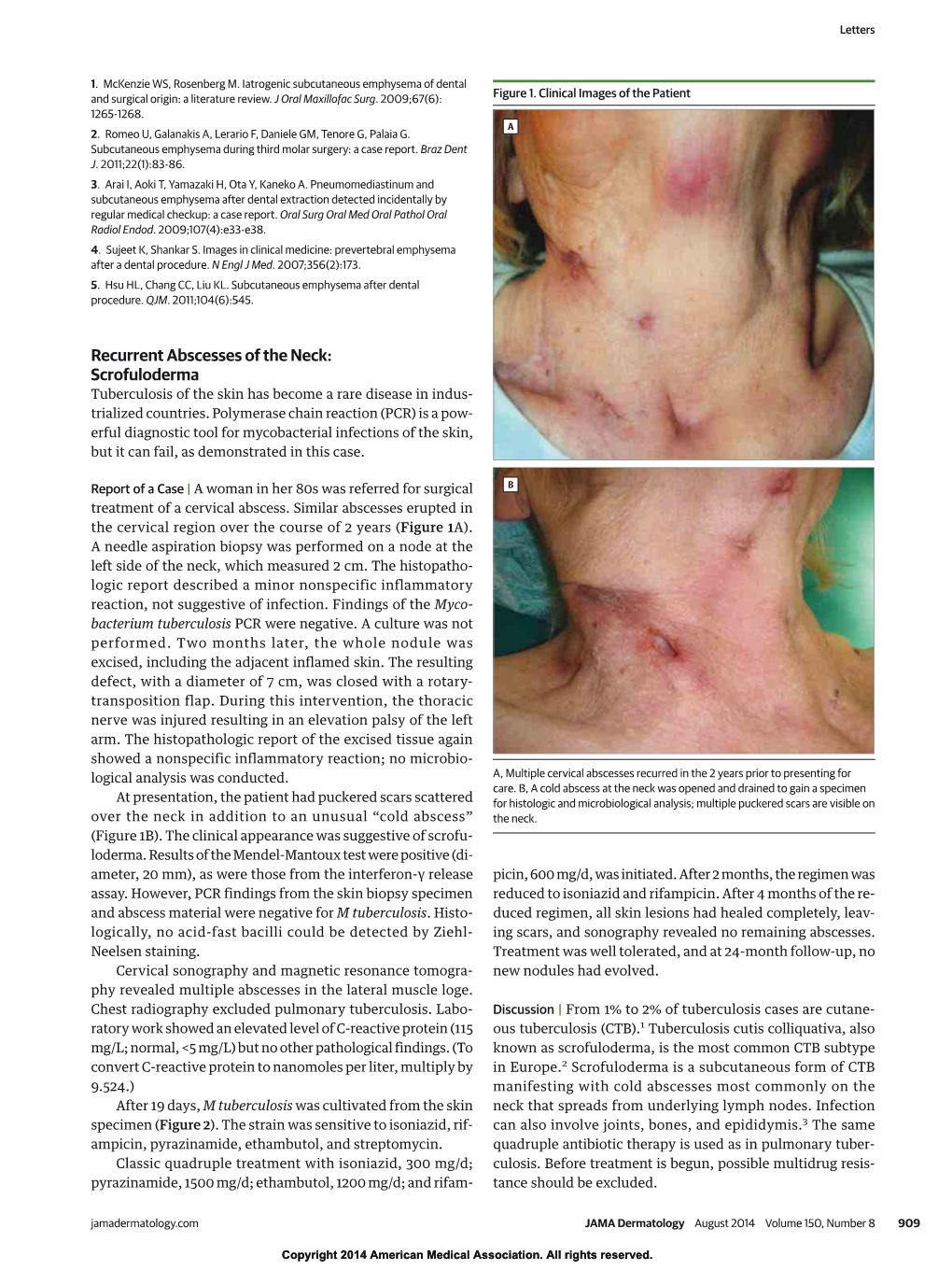 Recurrent Abscesses of the Neck: Scrofuloderma Tuberculosis of the Skin Has Become a Rare Disease in Indus- Trialized Countries