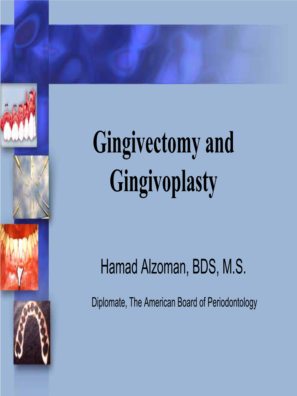 Gingivectomy and Gingivoplasty