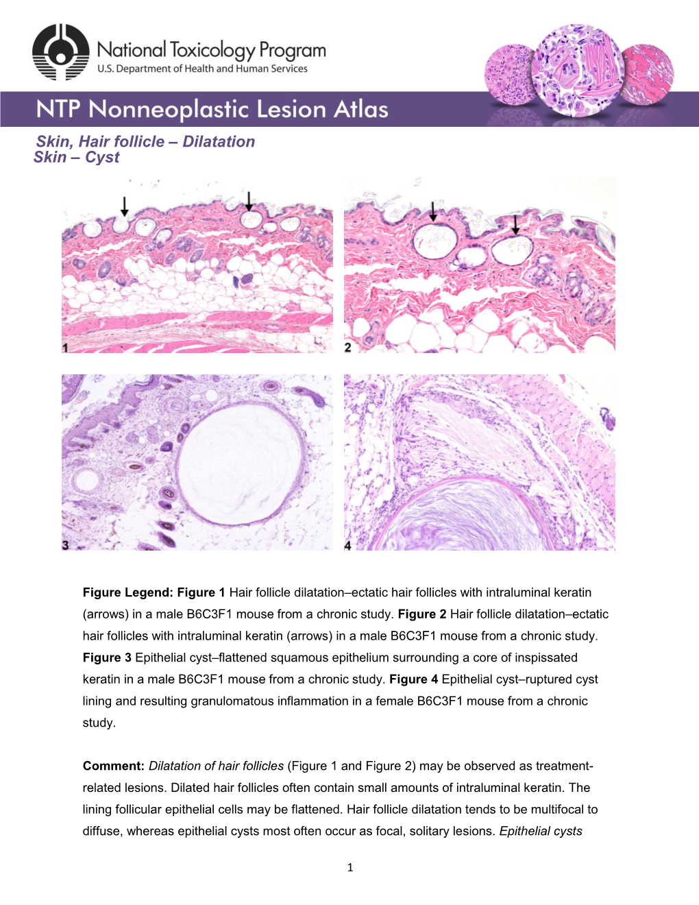 Skin, Hair Follicle – Dilatation Skin – Cyst